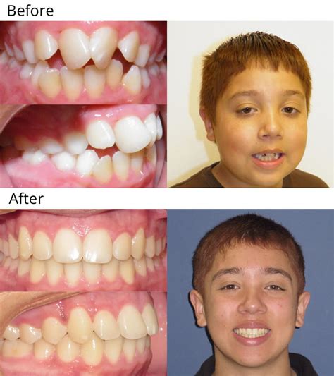 Unhappiness With Results of Orthodontics .